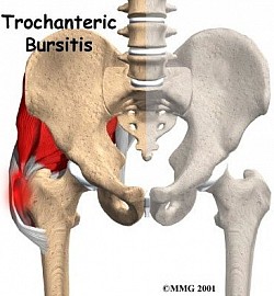 BURSITIS TROCANTEREA