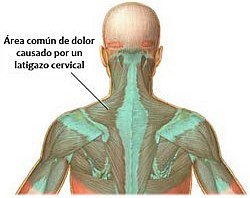 SÍNDROME DEL LATIGAZO CERVICAL 