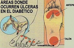 DOLOR NEUROPÁTICO DIABÉTICO 