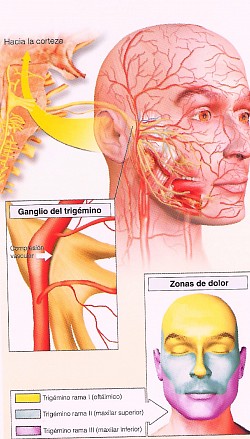 NEURALGIA DEL TRIGÉMINO 