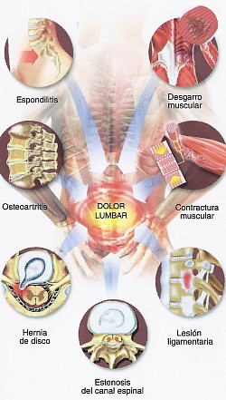 DOLOR LUMBAR CRONICO  